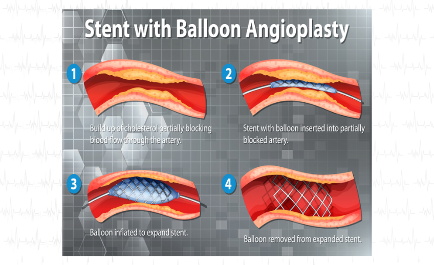  Angioplasty 