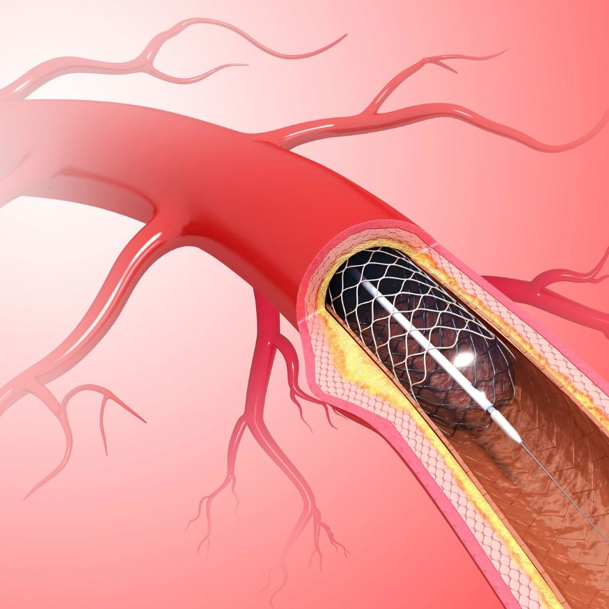  Angioplasty 