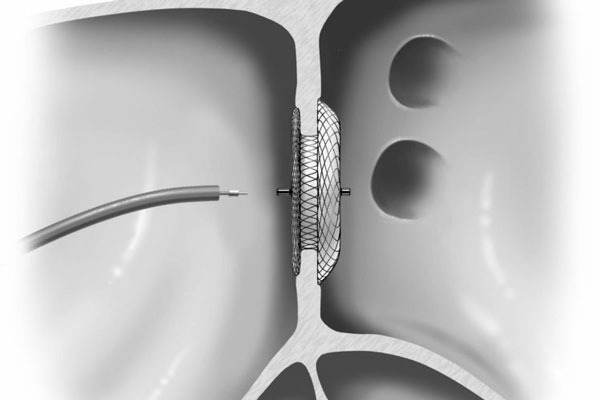 Device Closure Procedure