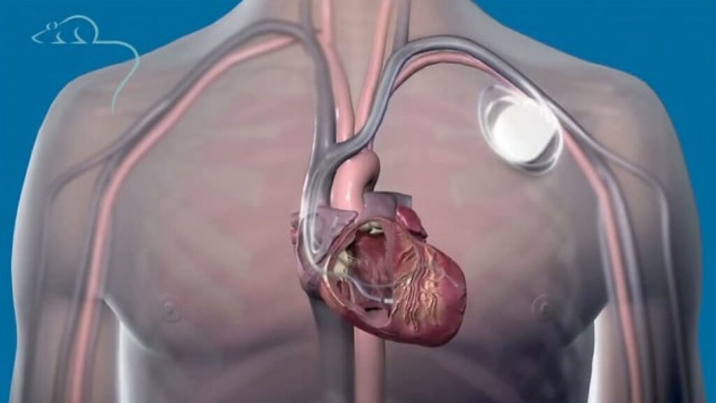 Pacemaker Implantation