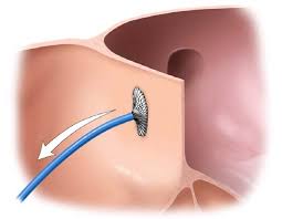 Congenital Heart Disease Treatment Device Closure of ASD,PDA