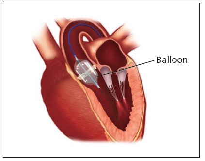 Balloon Valvotomy