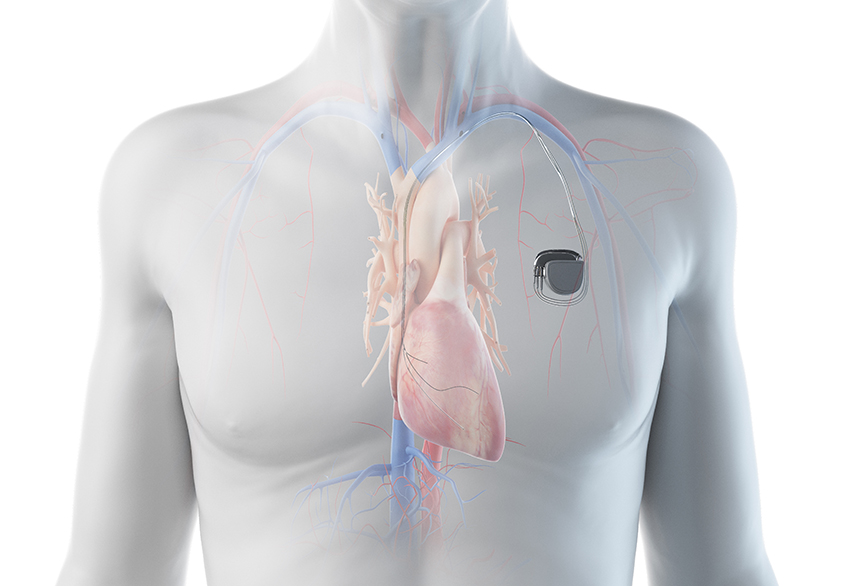 Permeant Pacemaker Implantation