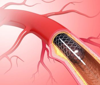 Angioplasty