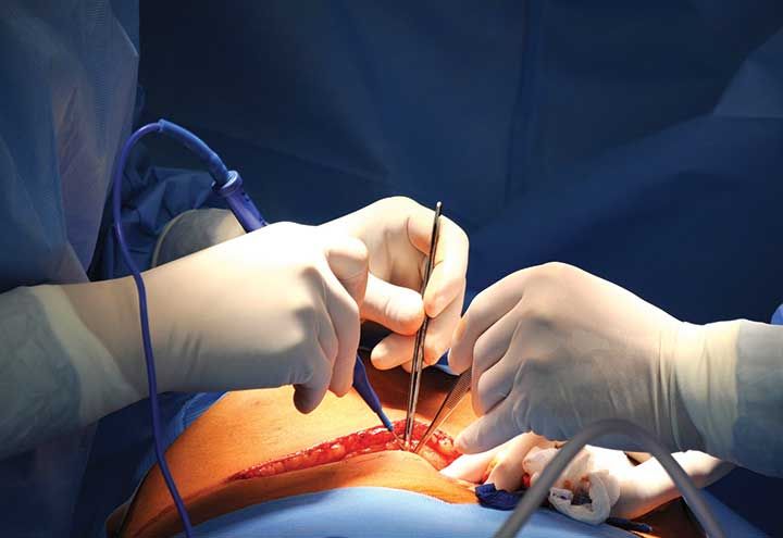 Infection at the Surgical Site